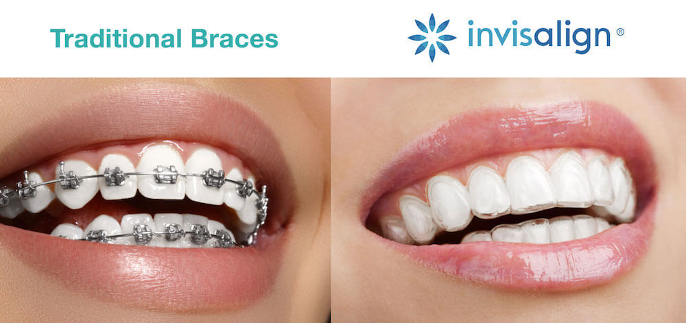 Get Your Invisalign Clear Braces At Our Ideal Smile, 58% OFF
